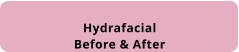HydrafacialBefore & After